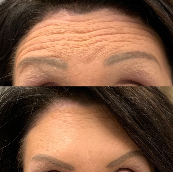 How long does Botox last in forehead?